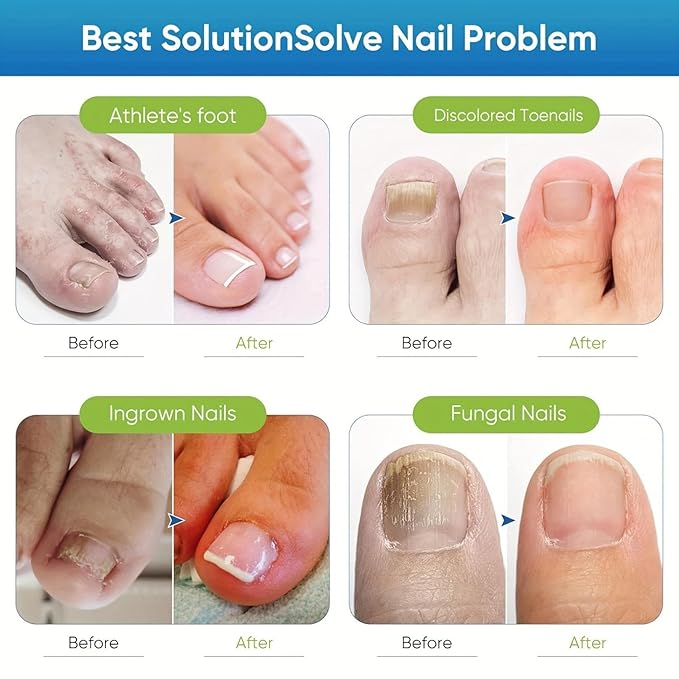 72 PCS NAIL PROTECT PATCHES | TOENAIL MAXIMUM STRENGTH