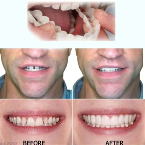 FIVFIVGO™ ADJUSTABLE SNAP-ON DENTURES