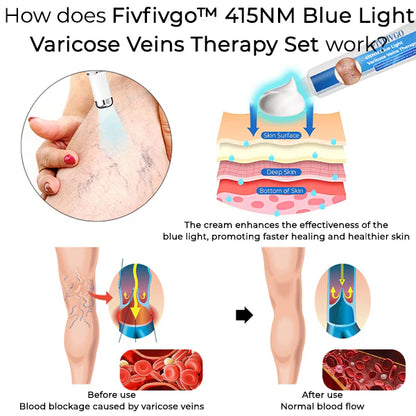 FIVFIVGO™ 415NM BLUE LIGHT VARICOSE VEINS THERAPY SET ⚡️FREE SHIPPING⚡️