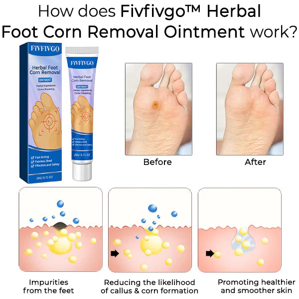 FIVFIVGO™ HERBAL FOOT CORN REMOVAL OINTMENT